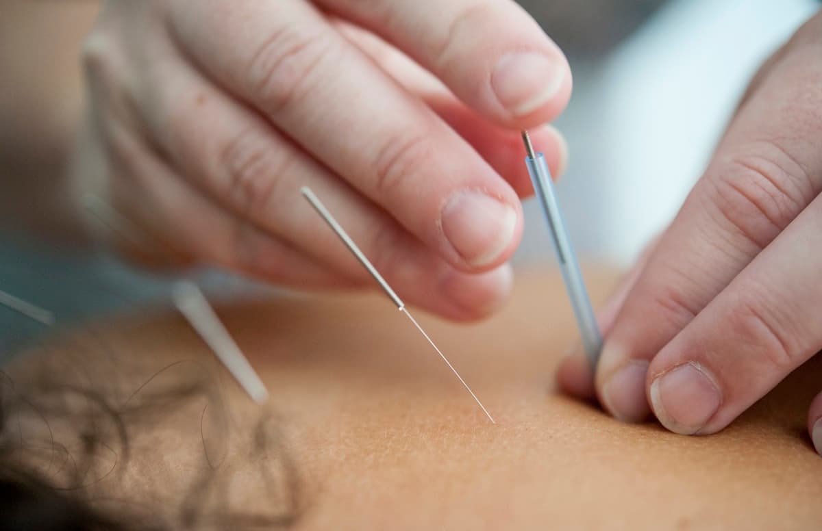 Akupunktur als Teil der Regulationsmedizin